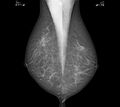 Bilateral sternalis muscle at mammography (Radiopaedia 24366-24657 A 1).jpg