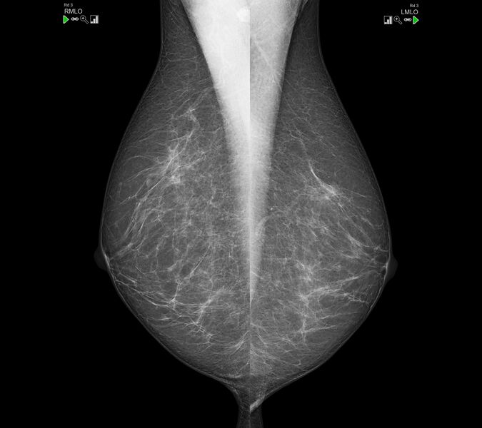 File:Bilateral sternalis muscle at mammography (Radiopaedia 24366-24657 A 1).jpg