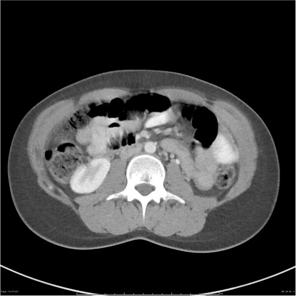 File:Bilateral ureteritis and cystitis (Radiopaedia 25340-25594 A 36).jpg