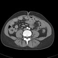 Biliary necrosis - liver transplant (Radiopaedia 21876-21845 A 41).jpg