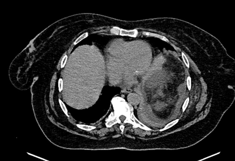 File:Biliary pancreatitis (Radiopaedia 72289-82823 Axial non-contrast 25).jpg
