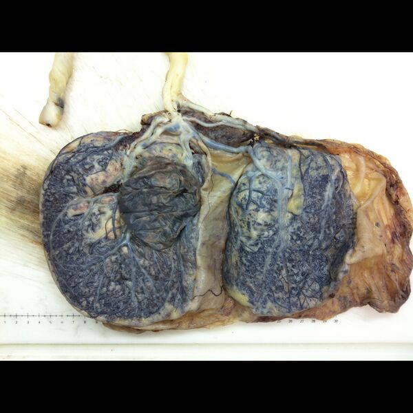 File:Bilobate placenta with velamentous insertion of the cord (gross pathology) (Radiopaedia 77582).jpeg
