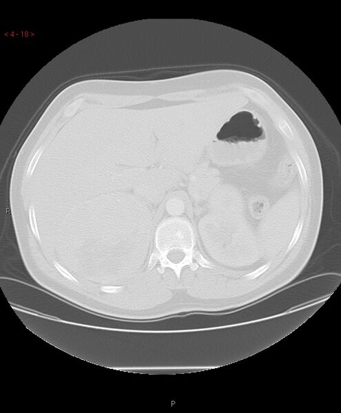 File:Birt-Hogg-Dubé syndrome (Radiopaedia 53814-60013 Axial lung window 18).jpg