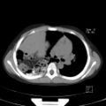 Bochdalek diaphragmatic hernia (Radiopaedia 38866-41059 A 10).jpg