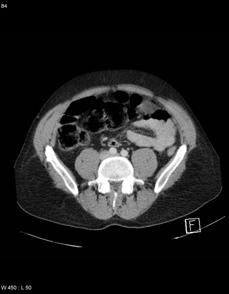 File:Boerhaave syndrome with tension pneumothorax (Radiopaedia 56794-63603 A 42).jpg