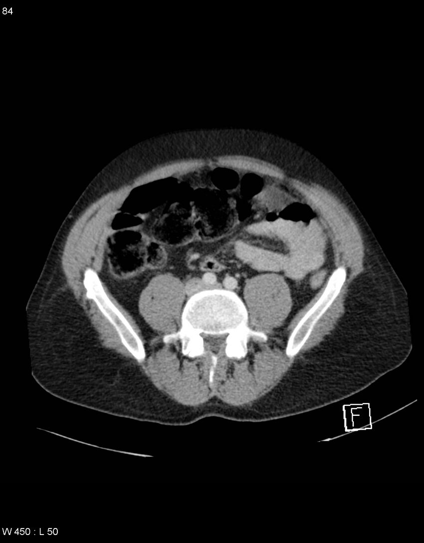 Boerhaave syndrome with tension pneumothorax (Radiopaedia 56794-63603 A 42).jpg