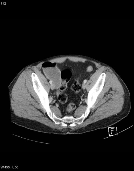 File:Boerhaave syndrome with tension pneumothorax (Radiopaedia 56794-63603 A 56).jpg