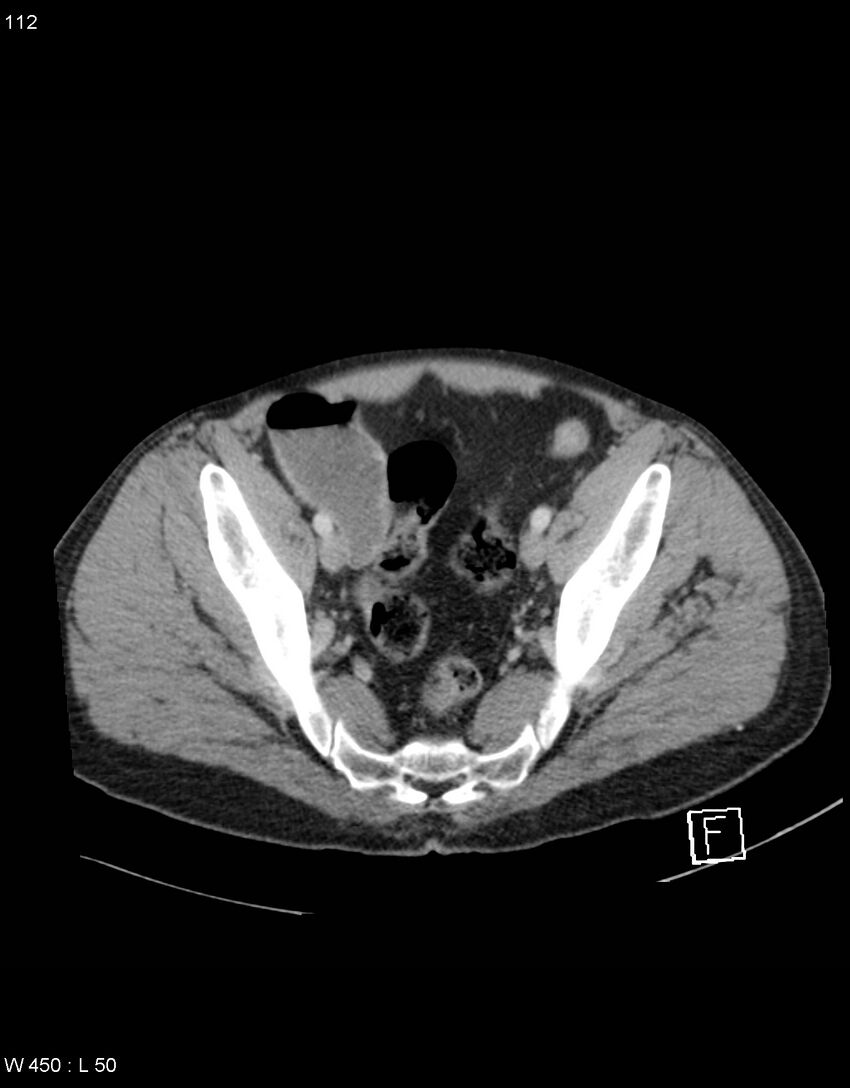 Boerhaave syndrome with tension pneumothorax (Radiopaedia 56794-63603 A 56).jpg