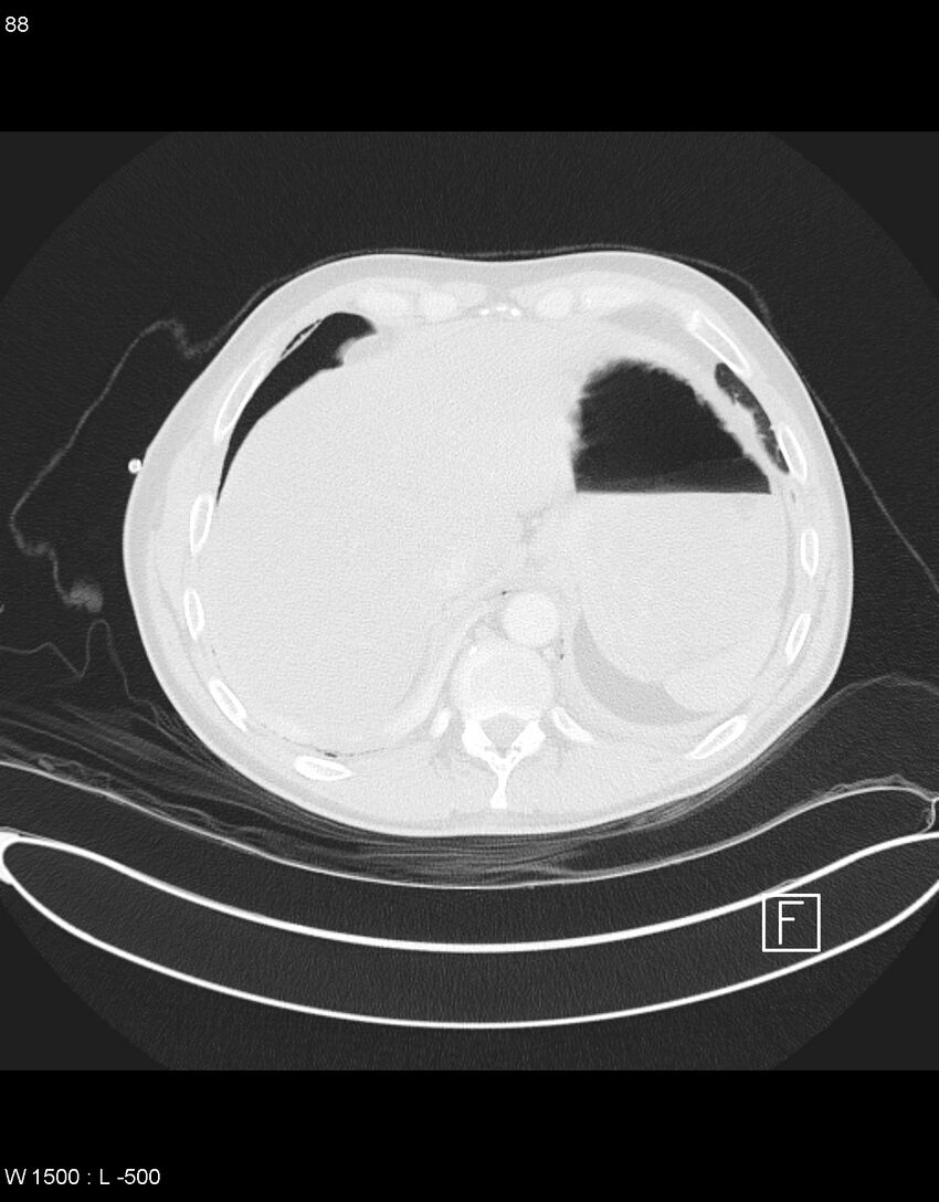 Boerhaave syndrome with tension pneumothorax (Radiopaedia 56794-63605 Axial lung window 43).jpg