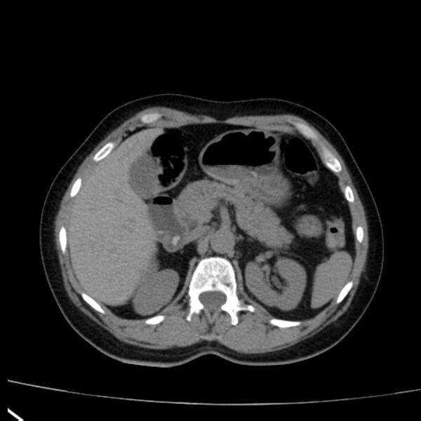 File:Bosniak renal cyst - type I (Radiopaedia 27479-27675 Axial non-contrast 27).jpg