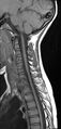 Brachial plexus birth palsy (Radiopaedia 68118-77604 Sagittal T1 8).jpg