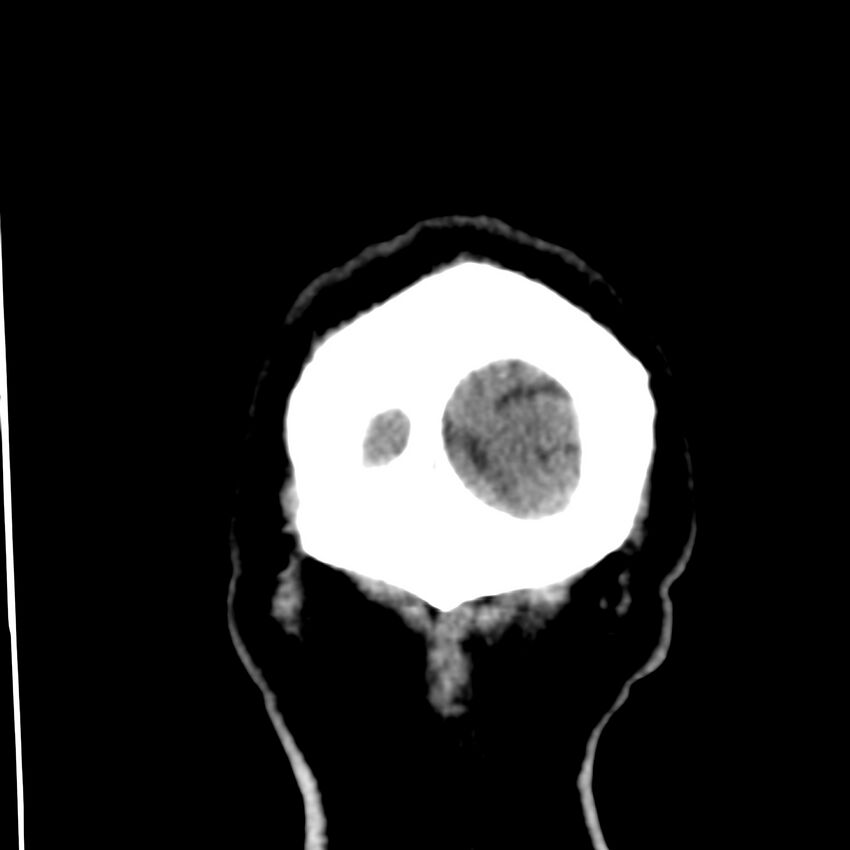 Brain Pantopaque remnants (Radiopaedia 78403-91048 Coronal non-contrast 70).jpg