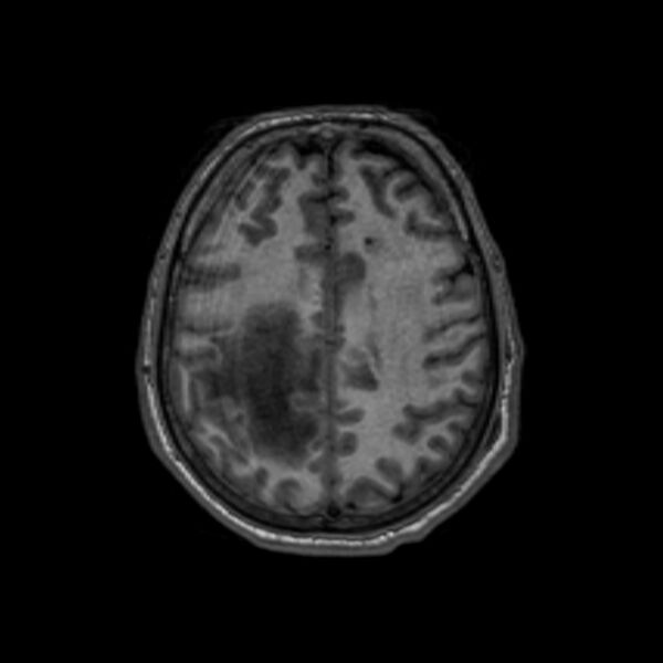 File:Brain abscess complicated by intraventricular rupture and ventriculitis (Radiopaedia 82434-96577 Axial T1 51).jpg
