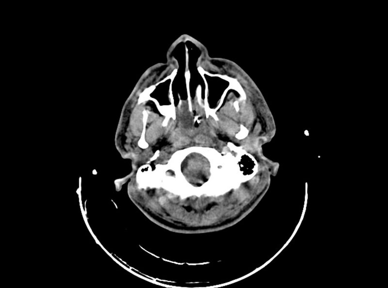 File:Brain injury by firearm projectile (Radiopaedia 82068-96087 B 44).jpg