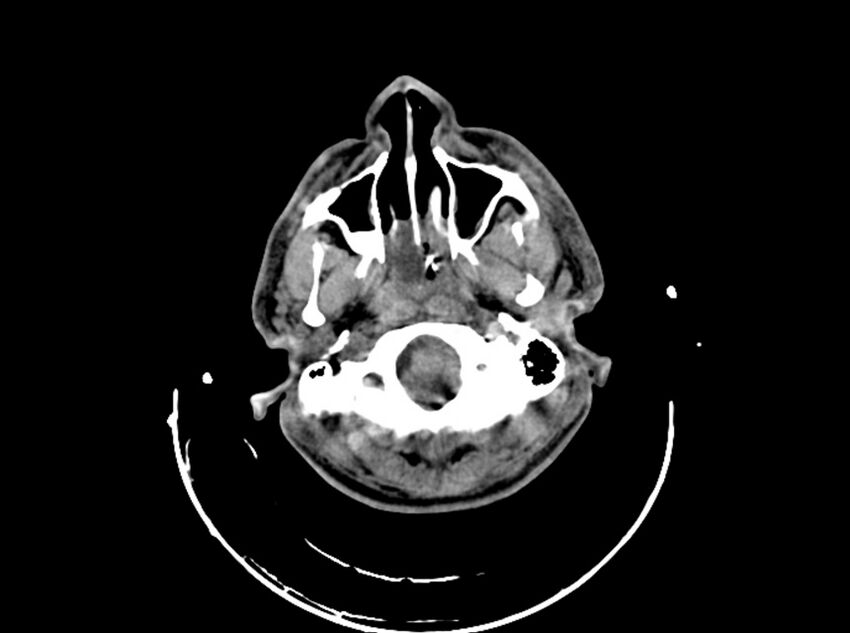 Brain injury by firearm projectile (Radiopaedia 82068-96087 B 44).jpg