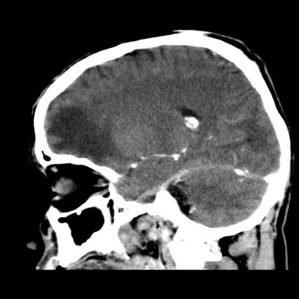 File:Brain metastases from lung cancer (Radiopaedia 24480-24781 C+ delayed 37).jpg