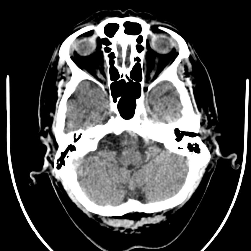 Brain metastasis (Radiopaedia 42617-45760 Axial non-contrast 7).jpg