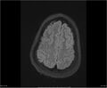 Brainstem glioma (Radiopaedia 21819-21775 Axial FLAIR 32).jpg