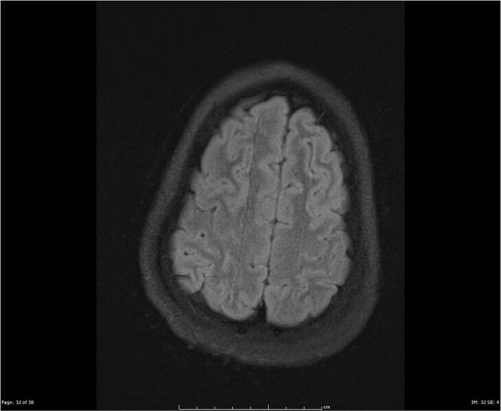 File:Brainstem glioma (Radiopaedia 21819-21775 Axial FLAIR 32).jpg