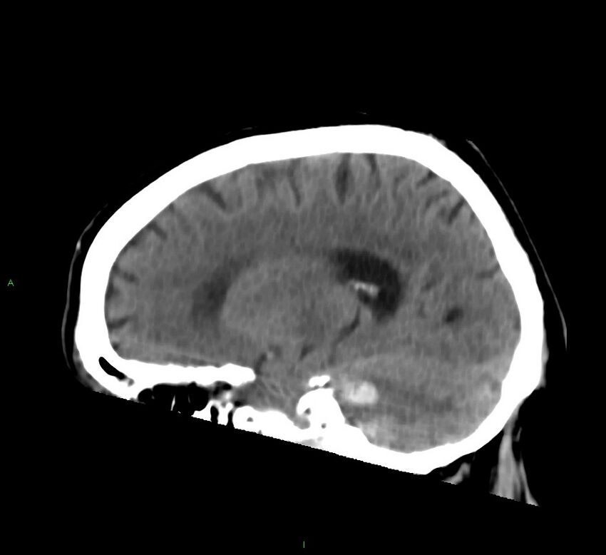 Brainstem hemorrhage (Radiopaedia 58794-66028 C 19).jpg