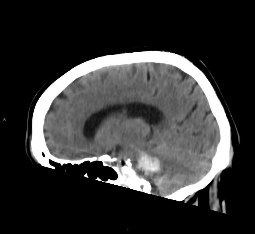 Brainstem hemorrhage (Radiopaedia 58794-66028 C 21).jpg