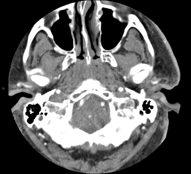 File:Brainstem hemorrhage (Radiopaedia 58794-66028 D 27).jpg