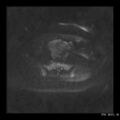 Broad ligament fibroid (Radiopaedia 49135-54241 Axial DWI 12).jpg