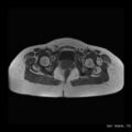 Broad ligament fibroid (Radiopaedia 49135-54241 Axial T1 13).jpg