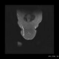 Broad ligament fibroid (Radiopaedia 49135-54241 Coronal STIR 1).jpg