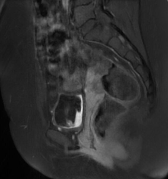 File:Broad ligament leiomyoma (Radiopaedia 81634-95516 G 13).jpg
