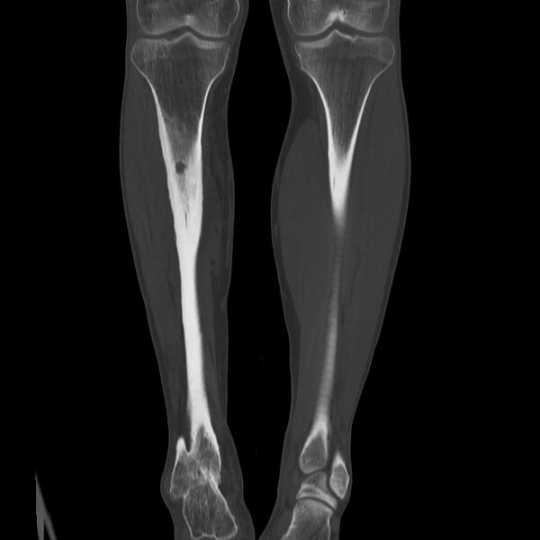File:Brodie abscess - tibia (Radiopaedia 66028-75204 Coronal bone window 35).jpg
