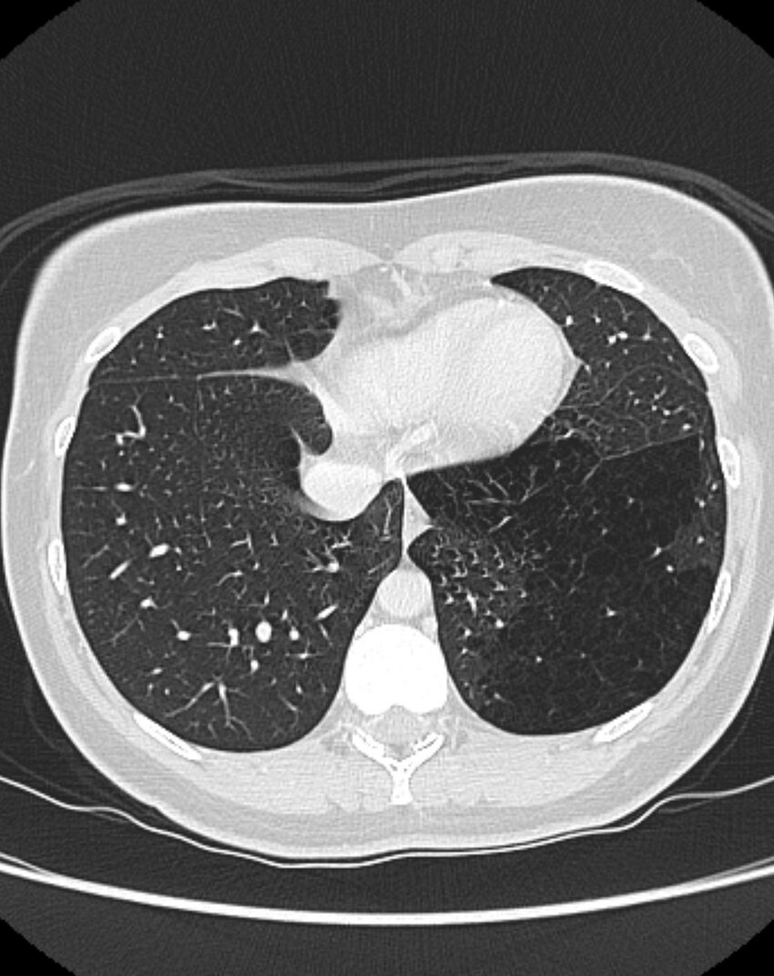 Bronchial atresia (Radiopaedia 50007-55297 Axial lung window 84).jpg