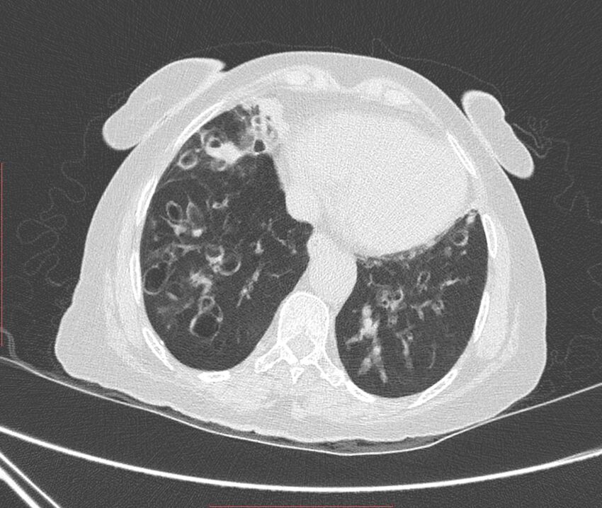 Bronchiectasis (Radiopaedia 72693-83293 Axial lung window 102).jpg