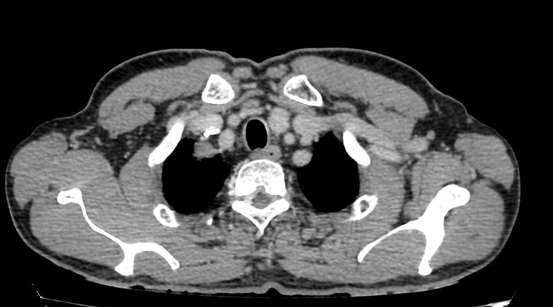File:Bronchogenic carcinoma with superior vena cava syndrome (Radiopaedia 36497-38054 Axial C+ delayed 3).jpg