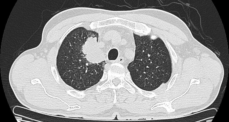 File:Bronchogenic carcinoma with superior vena cava syndrome (Radiopaedia 36497-38054 Axial lung window 25).jpg