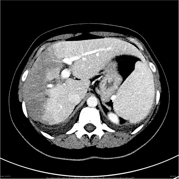 File:Budd-Chiari syndrome (Radiopaedia 27929-28177 Axial liver window 16).JPG