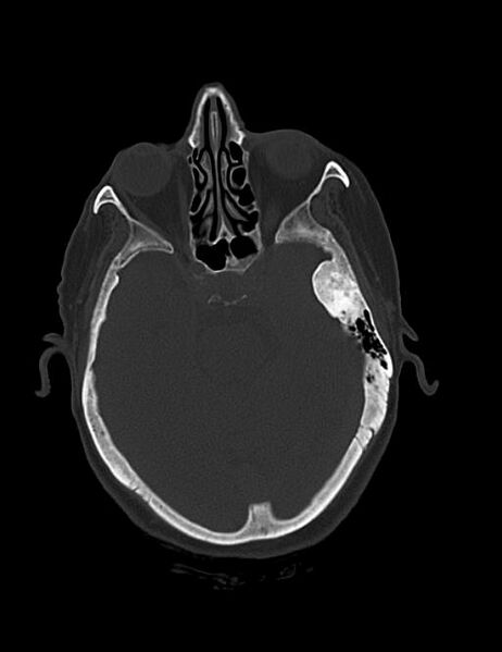 File:Burnt-out meningioma (Radiopaedia 51557-57337 Axial bone window 16).jpg