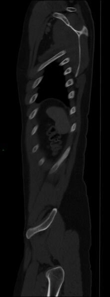 File:Burst fracture (Radiopaedia 83168-97542 Sagittal bone window 107).jpg