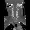 C1 anterior arch (plough) fracture - type 1 (Radiopaedia 76181-87720 Coronal bone window 49).jpg