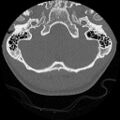 C5 facet fracture (Radiopaedia 58374-65499 Axial bone window 1).jpg
