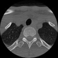 C5 facet fracture (Radiopaedia 58374-65499 Axial bone window 94).jpg