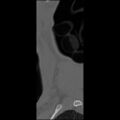 C5 facet fracture (Radiopaedia 58374-65499 Sagittal bone window 5).jpg