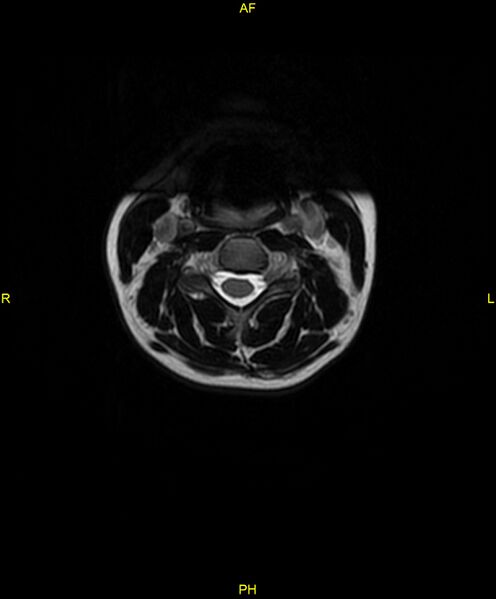 File:C5 nerve sheath tumor (Radiopaedia 85777-101596 Axial T2 20).jpg