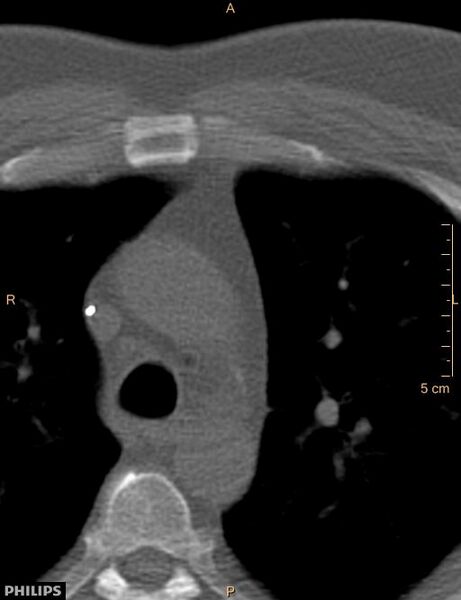 File:Calcified cardiac fibroma (Radiopaedia 39267-41519 Axial bone window 4).jpg