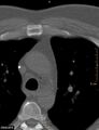 Calcified cardiac fibroma (Radiopaedia 39267-41519 Axial bone window 4).jpg