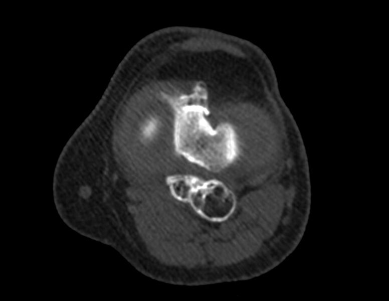 File:Calcified hematoma - popliteal fossa (Radiopaedia 63938-72763 Axial bone window 27).jpg