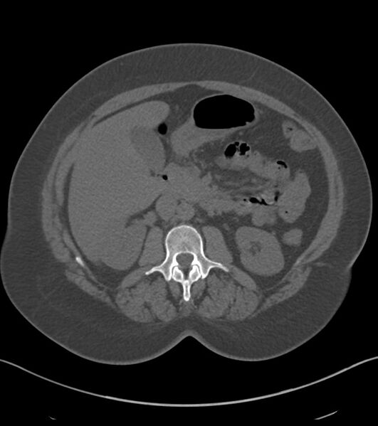 File:Calcified hepatic hydatid cyst (Radiopaedia 81127-94738 Axial non-contrast 41).jpg