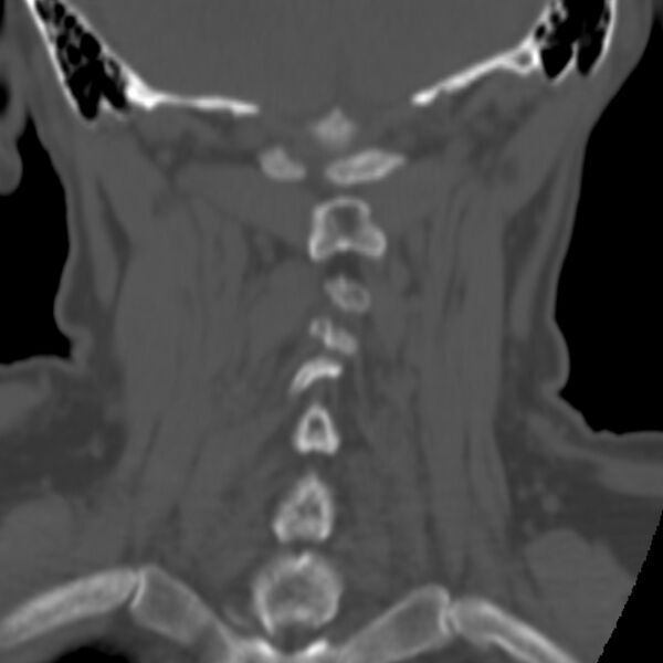 File:Calcified meningioma - cervical canal (Radiopaedia 70136-80171 Coronal bone window 29).jpg