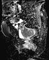 Cancer cervix - stage IIb (Radiopaedia 75411-86615 Sagittal ADC 9).jpg