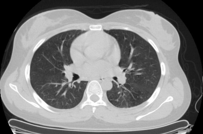 File:Cannonball metastases - uterine choriocarcinoma (Radiopaedia 70137-80173 Axial lung window 45).jpg